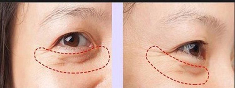 
Mi mắt có nhiều da thừa và bọng mỡ nên tiến hành phẫu thuật
