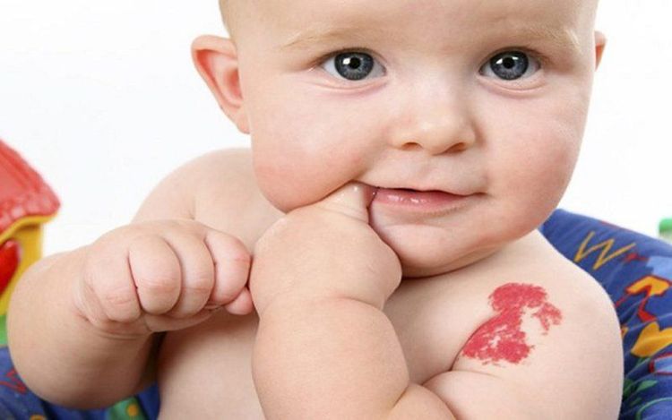 
U máu có thể xuất hiện ở mọi nơi trên cơ thể trẻ
