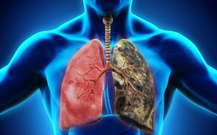 
Thuốc Ipratropium bromide có tác dụng điều trị các triệu chứng của ung thư phổi
