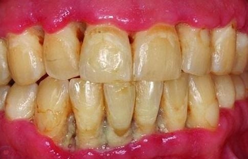
Viêm nha chu vừa làm giảm chất lượng cuộc sống của người bệnh vừa gây mất thẩm mỹ
