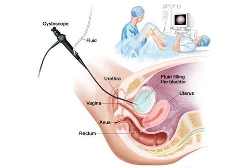 
Đặt sonde bàng quang cho bệnh nhân
