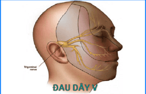 Đặc điểm cơn đau do u dây thần kinh số V