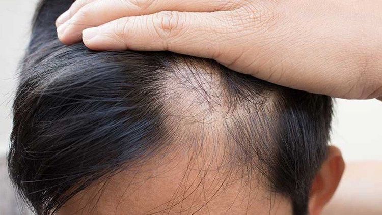 
Người có người chiều cao thấp thường dễ bị hói hơn người cao

