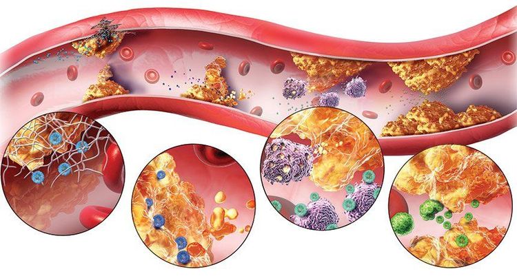 
Các thành phần lipid khác nguy cơ tạo nên các mảng xơ vữa ở thành động mạc
