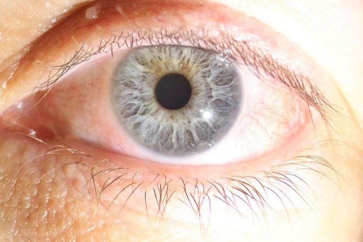 
Tình trạng khô mắt sau mổ Lasik
