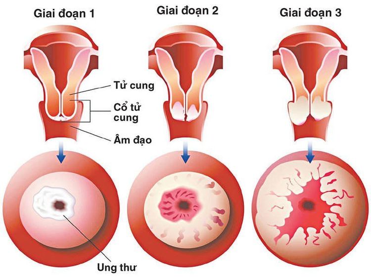 
Xét nghiệm Pap giúp tầm soát ung thư cổ tử cung
