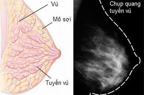 
U sợi tuyến vú ( bướu sợi tuyến vú) thường là khối u lành tính
