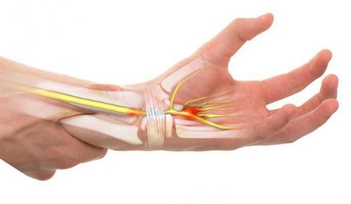 
Hội chứng ống cổ tay có thể gây ra nhiều ảnh hưởng đến hoạt động của người bệnh
