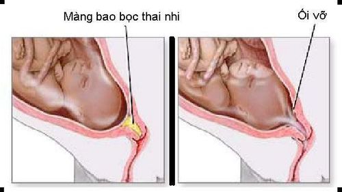 
vỡ ối non
