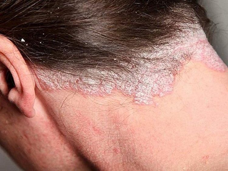 
Vảy nến xuất hiện ở gáy và cổ
