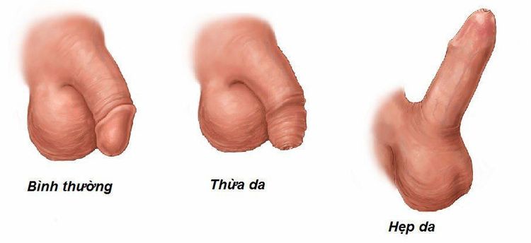 
Bao quy đầu bị dài và hẹp có thể gây viêm niệu đạo
