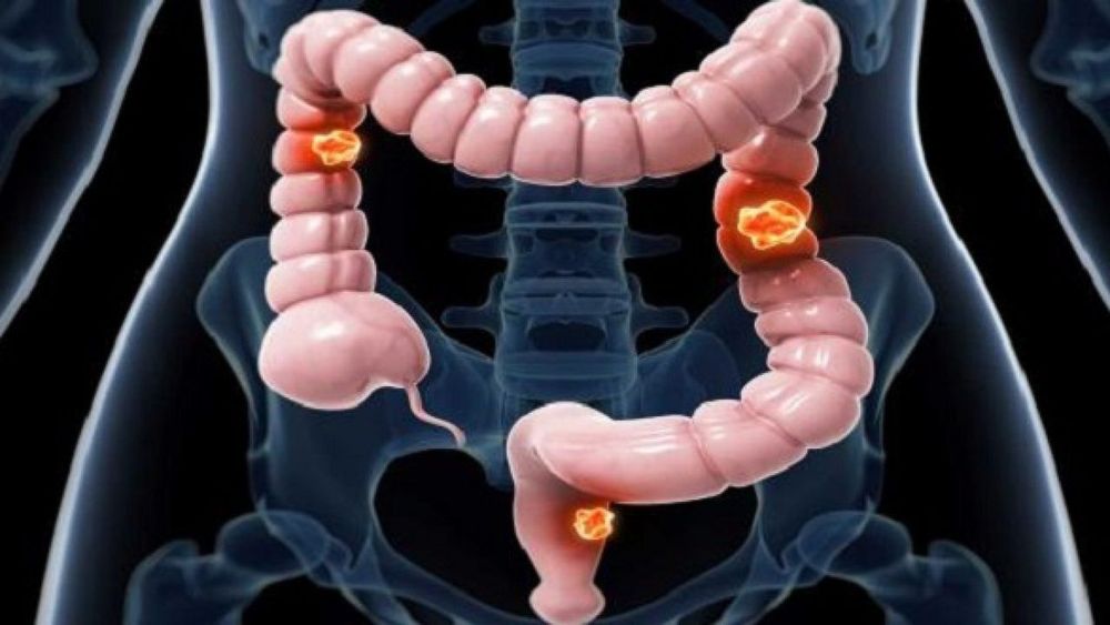 
Nội soi HD với i-scan phát hiện nhiều bệnh nhân ung thư đại trực tràng hơn đáng kể
