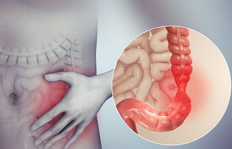 
Hình ảnh đại tràng bị co thắt
