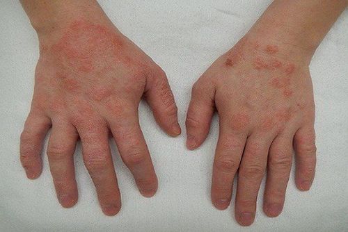 
Viêm da cơ địa ở trẻ biểu hiện như thế nào?
