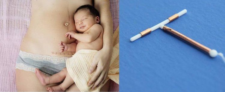 Đặt vòng sau sinh ba tháng có bị mất sữa không?