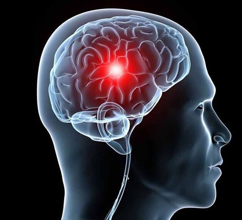 
Thiếu máu não thứ phát có thể tác động đến hệ thống lưới hoạt hoá làm suy giảm ý thức.
