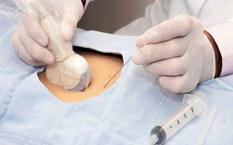 
Trong trường hợp phát hiện nang đám rối mạch mạc, bác sĩ có thể chỉ định thai phụ thực hiện kỹ thuật chọc ối
