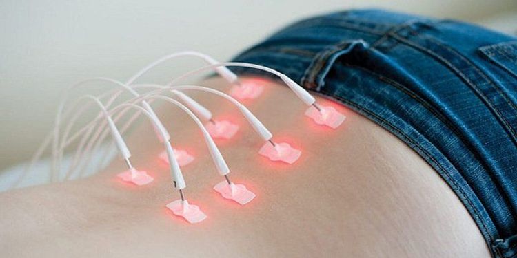 
Điều trị điện rất có hiệu quả đối với bệnh nhân đau dây thần kinh tọa

