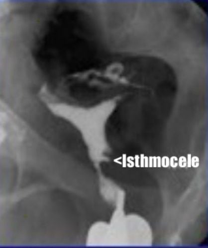 
Khuyết sẹo mổ lấy thai trên phim chụp HSG
