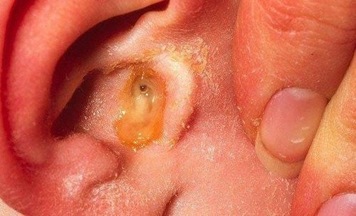 
Viêm tao giữa ở trẻ cần được phát hiện và điều trị sớm
