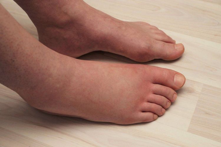 
Viêm cầu thận cấp gây phù
