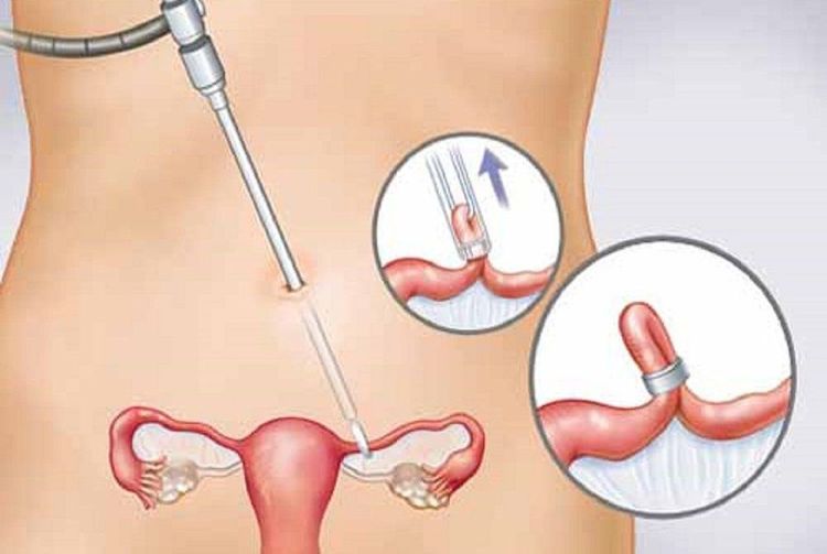 
Triệt sản nữ là biện pháp làm gián đoạn vòi tử cung
