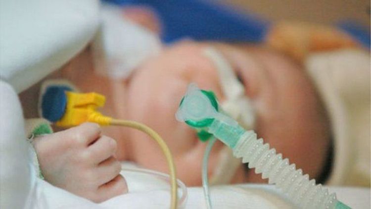 
Phần lớn trẻ mắc hội chứng Pallister-Killian khảm bị thoát vị hoành bẩm sinh
