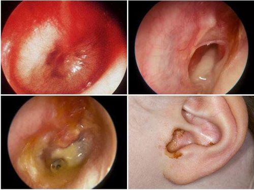 
Viêm tai giữa ở trẻ: Trẻ có bị sưng, tấy, đỏ, có máu hay chảy dịch trong tai
