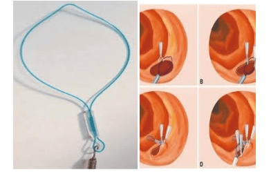 
Endoloop – Dụng cụ mới được áp dụng trong cầm máu qua nội soi do chảy máu từ túi thừa đại tràng
