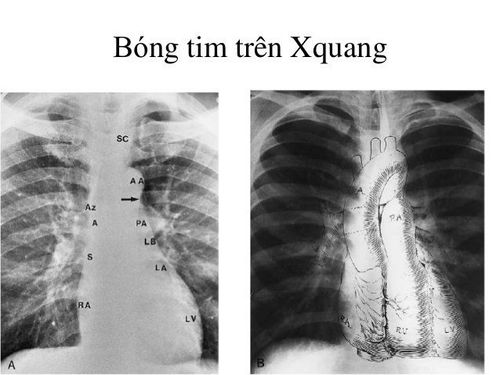
Bóng tim trên x quang
