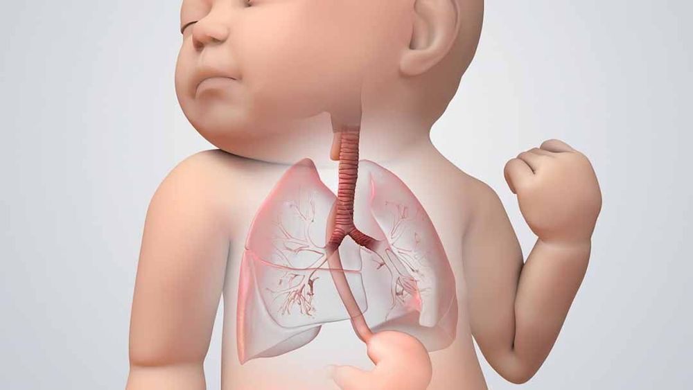 
Teo thực quản gây suy hô hấp
