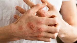 
Viêm da cơ địa là bệnh lý ngoài da

