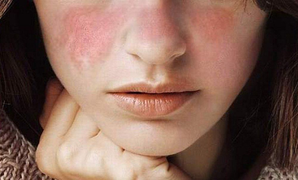 Tình trạng bệnh Lupus ban đỏ hệ thống với biểu hiện ban da