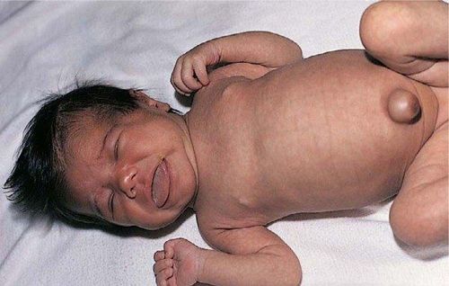 
Trẻ bị suy giáp bẩm sinh với đặc điểm thoát vị rốn, lưỡi to
