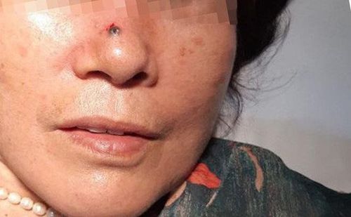 
Thông qua đo sóng âm mũi, bác sĩ sẽ đánh giá được sự thông thoáng mũi và theo dõi các bệnh lý ở mũi khách quan
