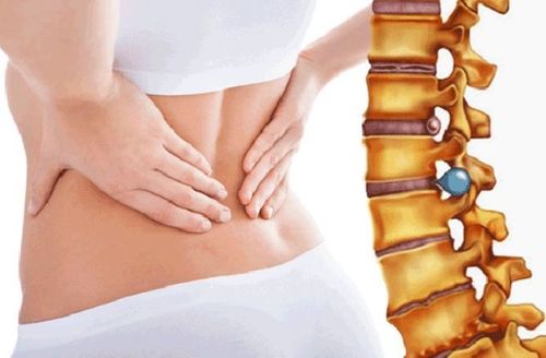 
Thoát vị đĩa đệm gây ra hội chứng rễ thần kinh
