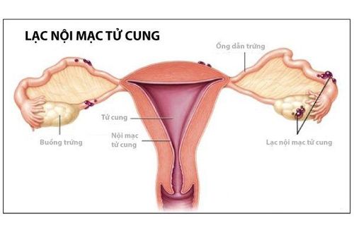 
U lạc nội mạc tử cung
