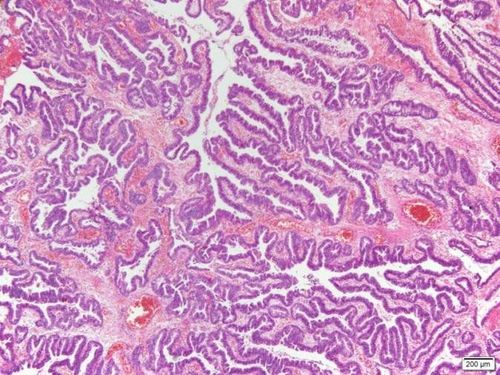 
Marsh loại III làm hủy hoại các tế bào biểu mô và teo biểu mô
