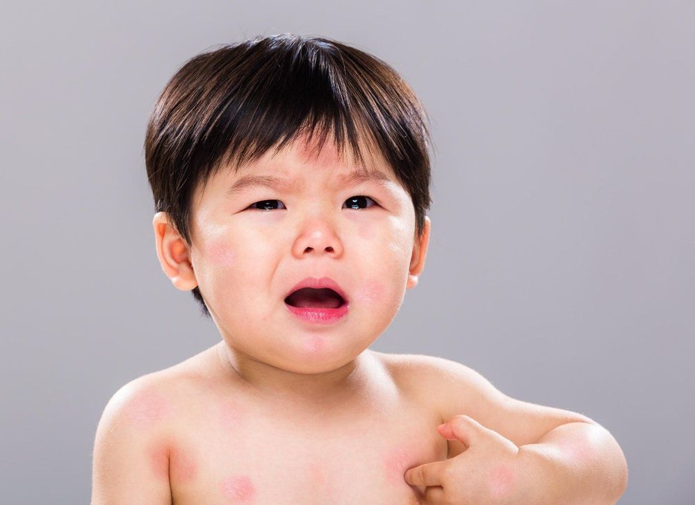 
Dị ứng với đạm sữa bò có thể là nguyên nhân gây đau bụng ở trẻ sơ sinh
