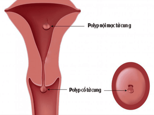 Polyp cổ tử cung. 