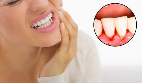 
Hôn chỉ lây nhiễm HIV khi cả 2 người bị chảy máu chân răng
