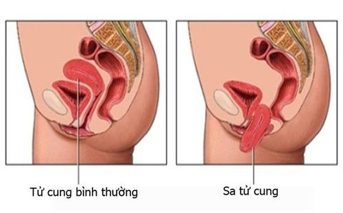 
Sự khác biệt tử cung giữa người bình thường và người mắc bệnh
