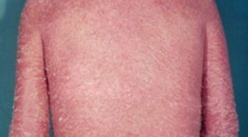 
Người bệnh dị ứng thuốc đỏ toàn thân cần được chăm sóc chu đáo
