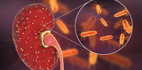 
Viêm bể thận do viêm niệu đạo ngược dòng
