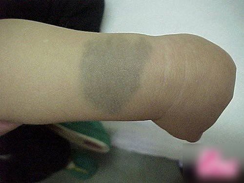 Bớt xanh là biểu hiện của rối loạn sắc tố da bẩm sinh