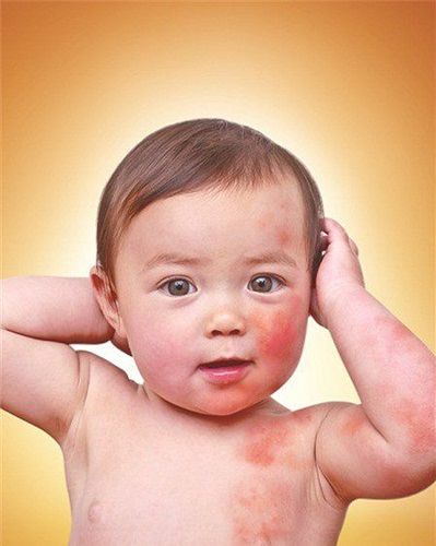 
Vết loét lạnh là những mụn nước nhỏ, bên trong chứa dịch thường xuất hiện ở gần hoặc trên môi
