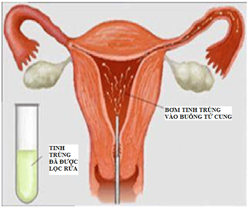 
Hình ảnh bơm tinh trùng vào buồng tử cung
