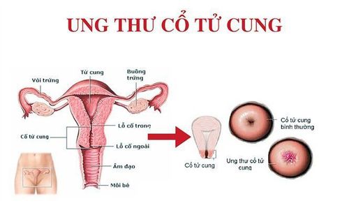 
Ung thư cổ tử cung do HPV
