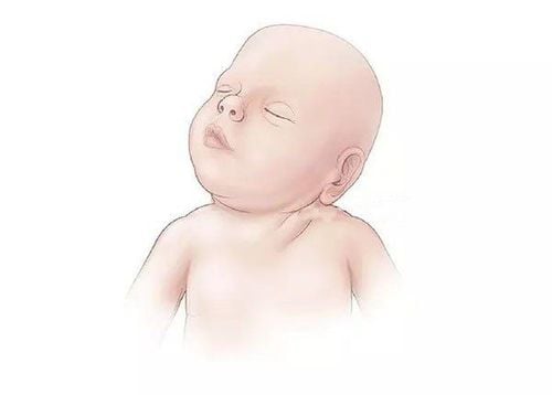 
Cha mẹ phát hiện các dấu hiệu vẹo cổ ở trẻ sơ sinh thì cần đưa trẻ đến bệnh viện để kiểm tra ngay lập tức

