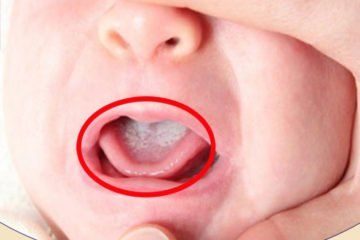 
Trẻ em dễ bị tưa miệng do nấm candida
